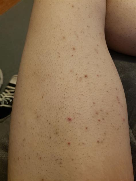 Skin Concern My Legs Are Awful From Shaving Yes I Exfoliate And Yes