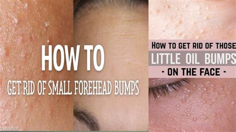 How To Get Rid Of Small Tiny Bumps On Foreheadface Simple Easy Home Remedies Youtube