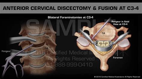 Anterior Cervical Discectomy And Fusion At C3 4 Youtube
