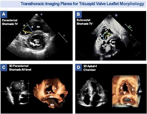 Key Echocardiographic Considerations For Tricuspid Valve Transcatheter