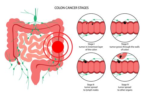 CÁncer De Colon Dr Neeraj Singh