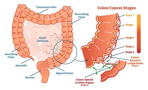 Colon And Rectal Cancer Colorectal Cancer Treatment Alaska Surgical