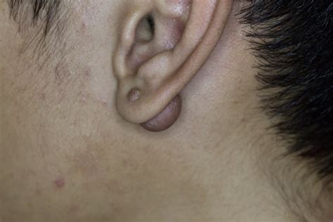10 Symptoms And Treatments For Keloids Facty Health