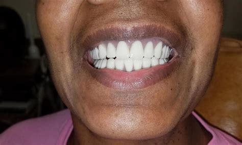 Dentures In Gretna LA Smile Gallery We Love Beautiful Teeth