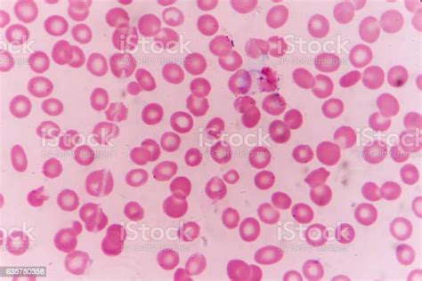 Blast Cells In Leukemia Stock Photo Download Image Now Thalassemia