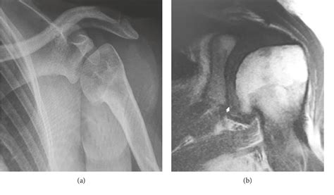 Figure 1 From Suprascapular Nerve Pulsed Radiofrequency For Chronic