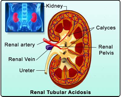 Renal Tubular Acidosis RTA Causes Types Diagnosis Treatment Complications