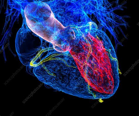 Heart In Coronary Artery Disease 3d Ct Scan Stock Image
