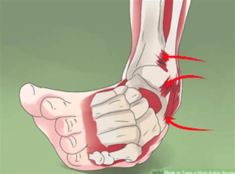 Ankle Sprain Tips Robbins Rehabilitation West