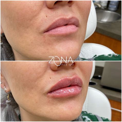 Restylane Kysse The Newest Fda Approved Filler For The Lips Zona Med Spa