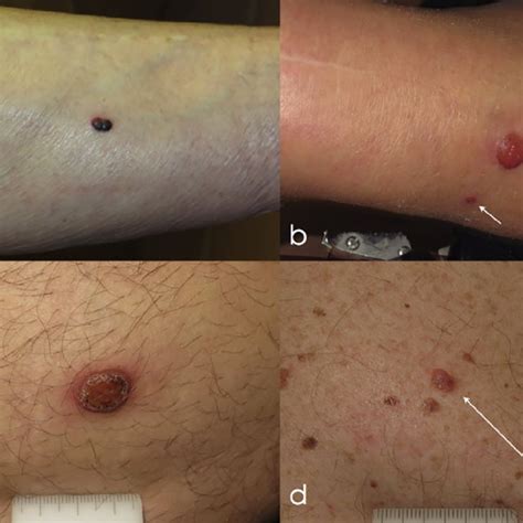 Clinical Presentation Of 4 Nodular Lesions Excised To Rule Out