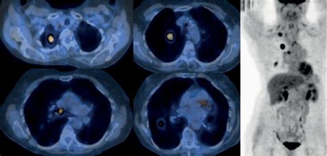 Pet Scan Images Lung Cancer