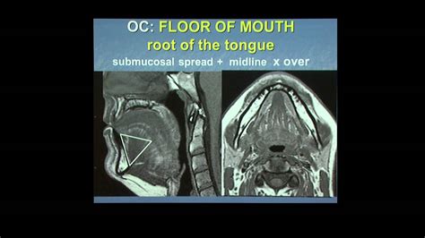 Floor Of Mouth Anatomy Ct Review Home Co