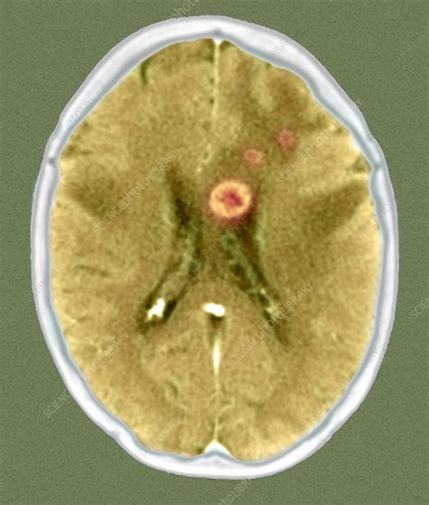 Secondary Brain Cancers Ct Scan Stock Image M1340509 Science