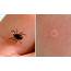 Lyme Disease Outbreak What Are The Symptoms Of How To 