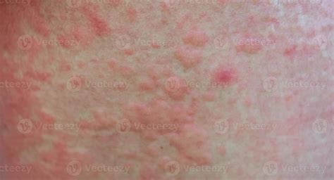 Urticarial Rash From Drug Allergy 14939408 Stock Photo At Vecteezy