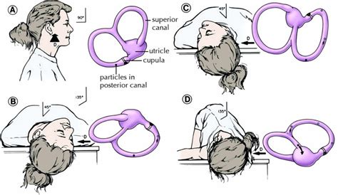 L Epley Maneuver