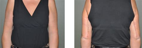 Common Questions About Arm Lift Surgery Brachioplasty Explore
