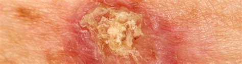 Squamous Cell Skin Cancer On Arm
