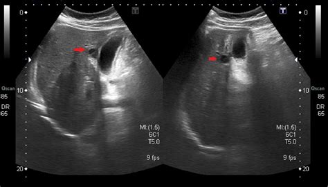 Gallbladder Perforation Radiological Aspects Types And Causes