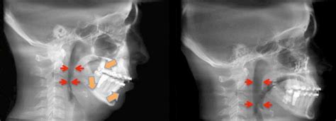 Recessed Maxilla Before After Face Pulling Results On Adults