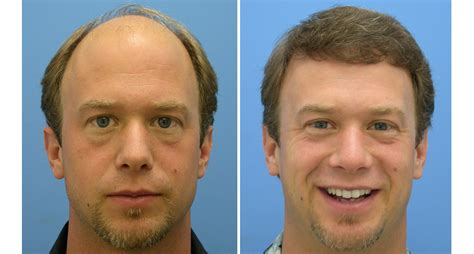 Composition and structure of hair. Hair Transplant Reviews | Hasson and Wong Reviews