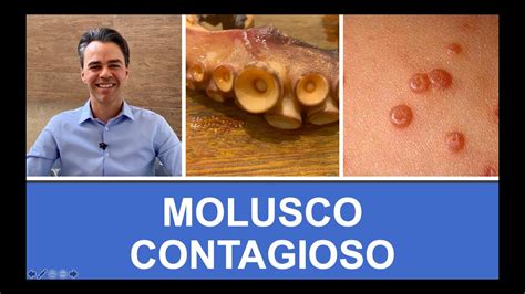 O Que É Molusco Contagioso Como Tratar Youtube