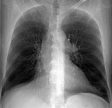 Pulmonary Artery Enlarged Chest X Ray Sexiezpicz Web Porn
