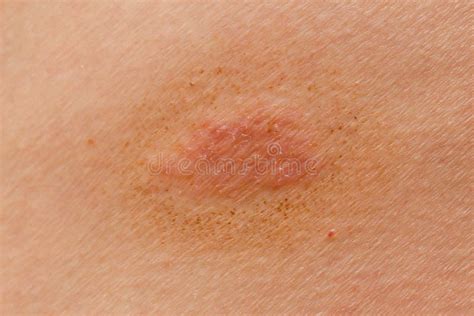 1351 Ringworm Photos Free And Royalty Free Stock Photos From Dreamstime