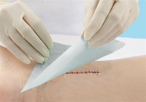 Incision Care And The Prevention Of Surgical Site Infections Medline