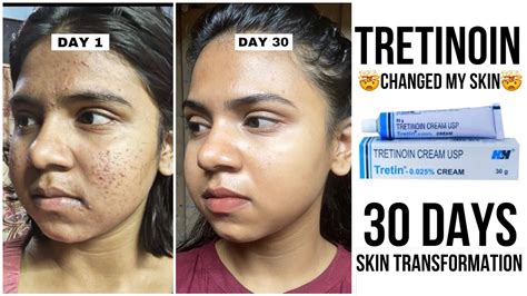 30 Days Skin Tansformation With Tretinoin How To Use Tretinoin
