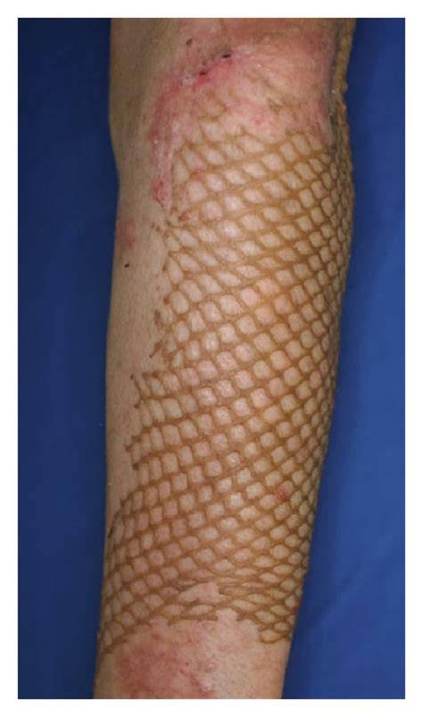 Treatment Of Mesh Skin Grafted Scars Using A Plasma Skin Regeneration