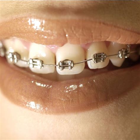 Check spelling or type a new query. How to Prevent White Spots From Braces | Healthy Living