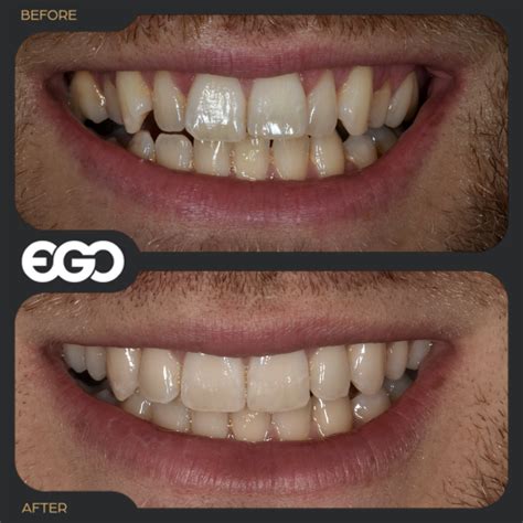 1 Ego Templatekey New 2022021 The Official Ego Dental Clinic Westminster