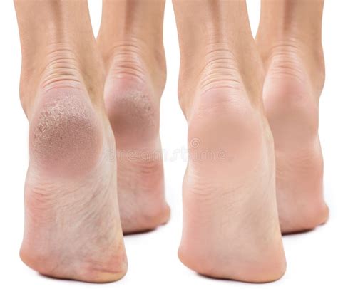 Feet With Dry Skin Before And After Treatment Stock Photo Image Of