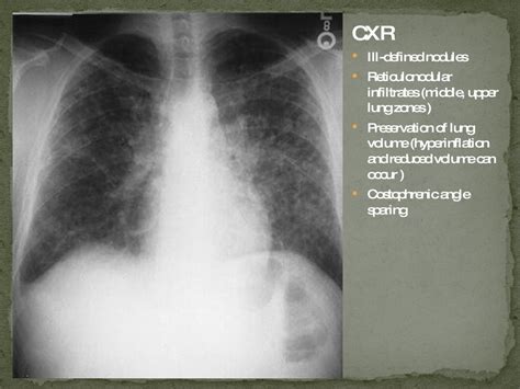 Pulmonary Langerhans Cell Histiocytosis Plch Eosinophilic Granulom