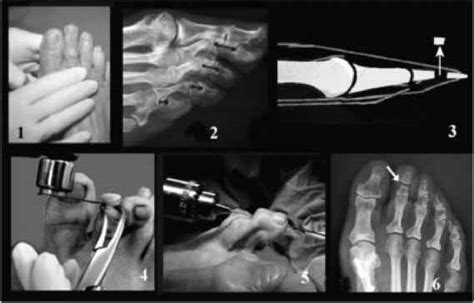 Middle Phalanx Osteotomies Hallux Valgus Barnard Health Care