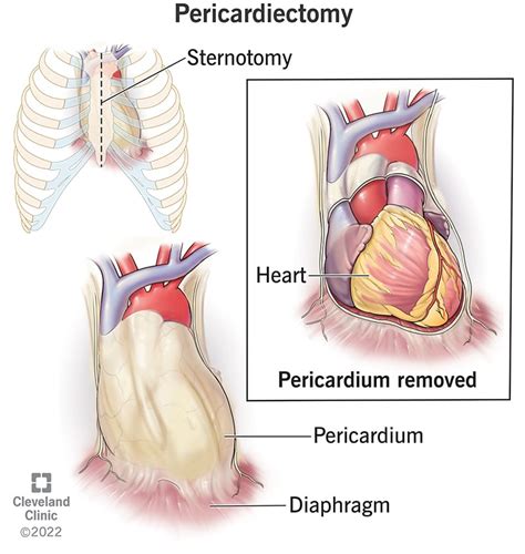 Pericardial Effusion Symptoms Causes And Treatment 42 Off