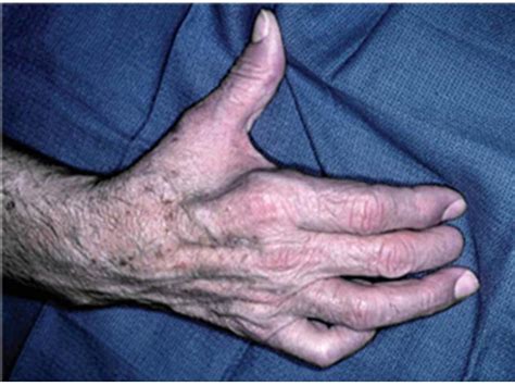 Peripheral Nerves Injury And Repair Hand Medbullets Step 1
