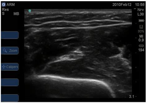 Ultrasound Guided Local Anaesthetic Blocks Of The Forearm Wfsa