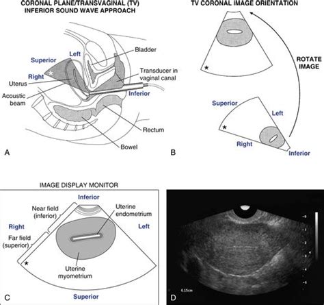 Transvaginal Scanning Protocol For The Female Pelvis Radiology Key My
