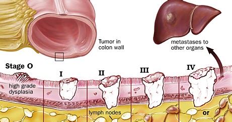 The tnm staging system was developed and is maintained by the ajcc and the union for international cancer control (uicc). TNM staging system ~ MESOTHELIOMA