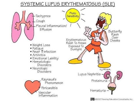 Diagnostic Criteria For Systemic Lupus Erythematosus Medical Show