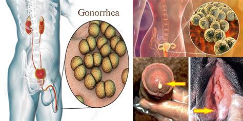 What Is Gonorrheatreatments And Prevention Good Health Facts