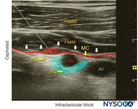 Ultrasoundguided Axillary Brachial Plexus Block
