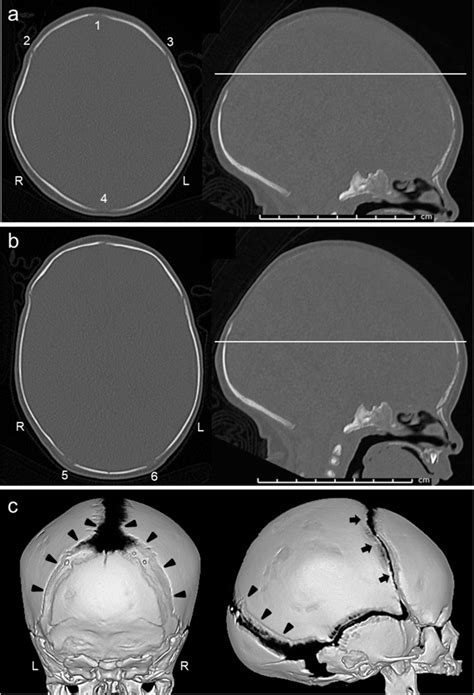 The Neonate Shows Wider Lambdoid And Sagittal Sutures Than Bilateral