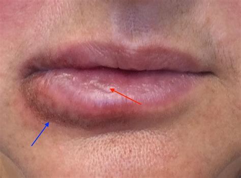 Cold Sore Under My Bottom Lip