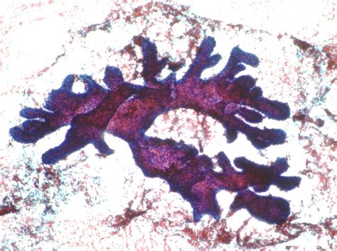 Breast Cytopathology