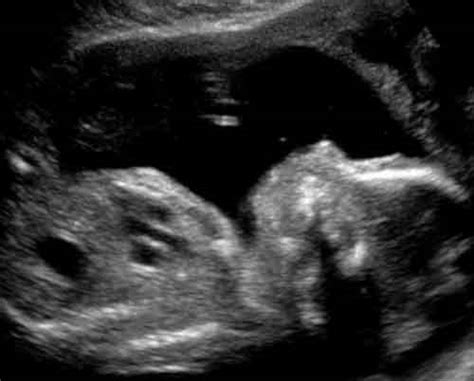 Baby Ultrasound Images Week 20