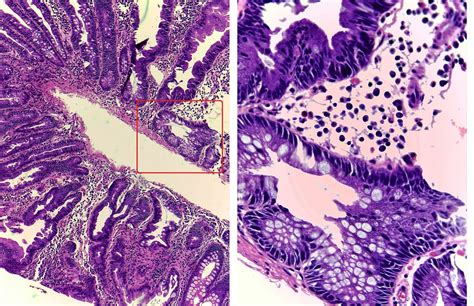 gastrointestinal and liver histology pathology atlas sessile serrated polyp aka sessile
